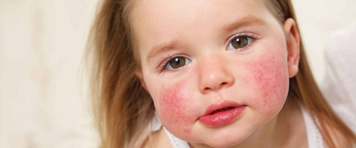 little girl with red cheeks, symptoms of allergies