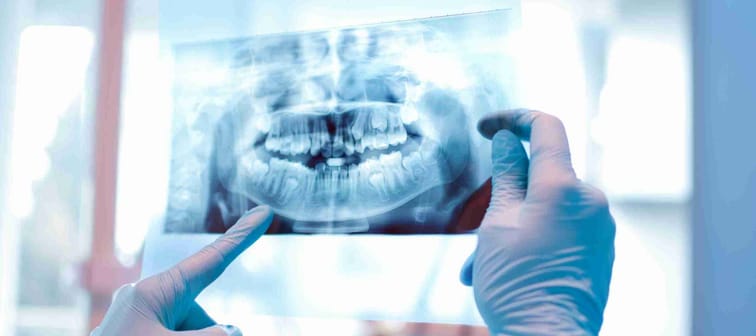 An X-ray of teeth showing a root canal
