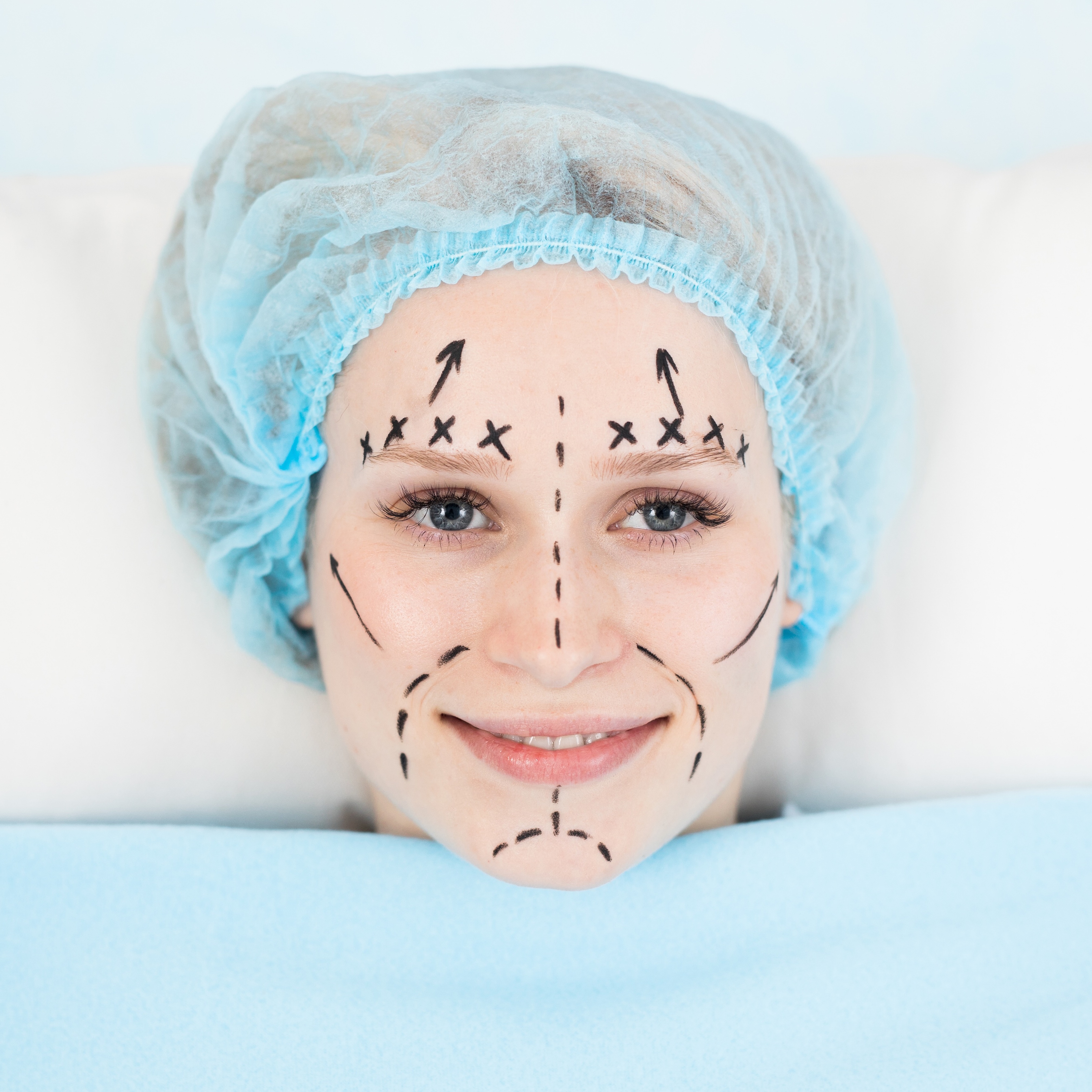 A woman smiles with surgical guide marks drawn on her face and a hairnet while under a blanket on an operating table.